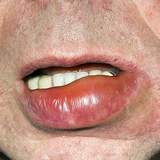 Övrənin müalicəsi